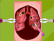 Mori's Lung Surgery