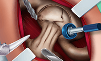 Ella : chirurgie des hanches